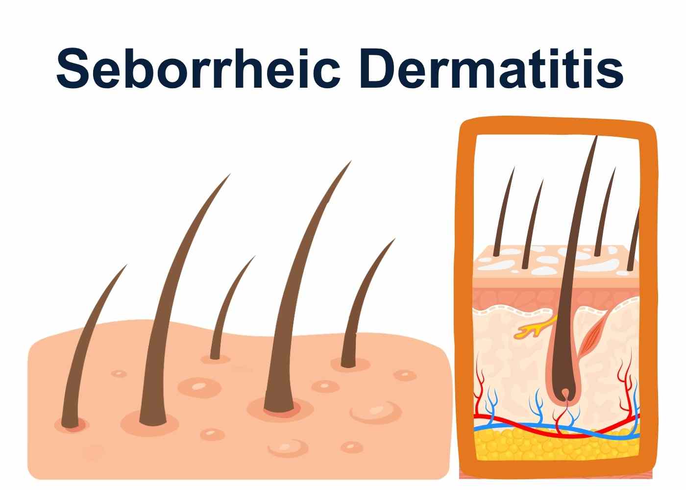 seborrheic-dermatitis